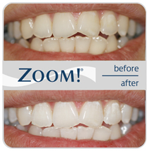 Zoom Before and After photo 3