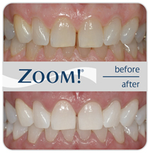 Zoom Before and After photo 2